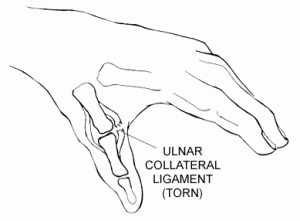 Lesión del pulgar del esquiador