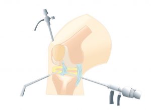 Artroscopia de rodilla